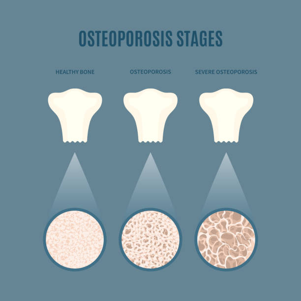 Physical Therapy for Osteoporosis - Types of Exercises to Focus On